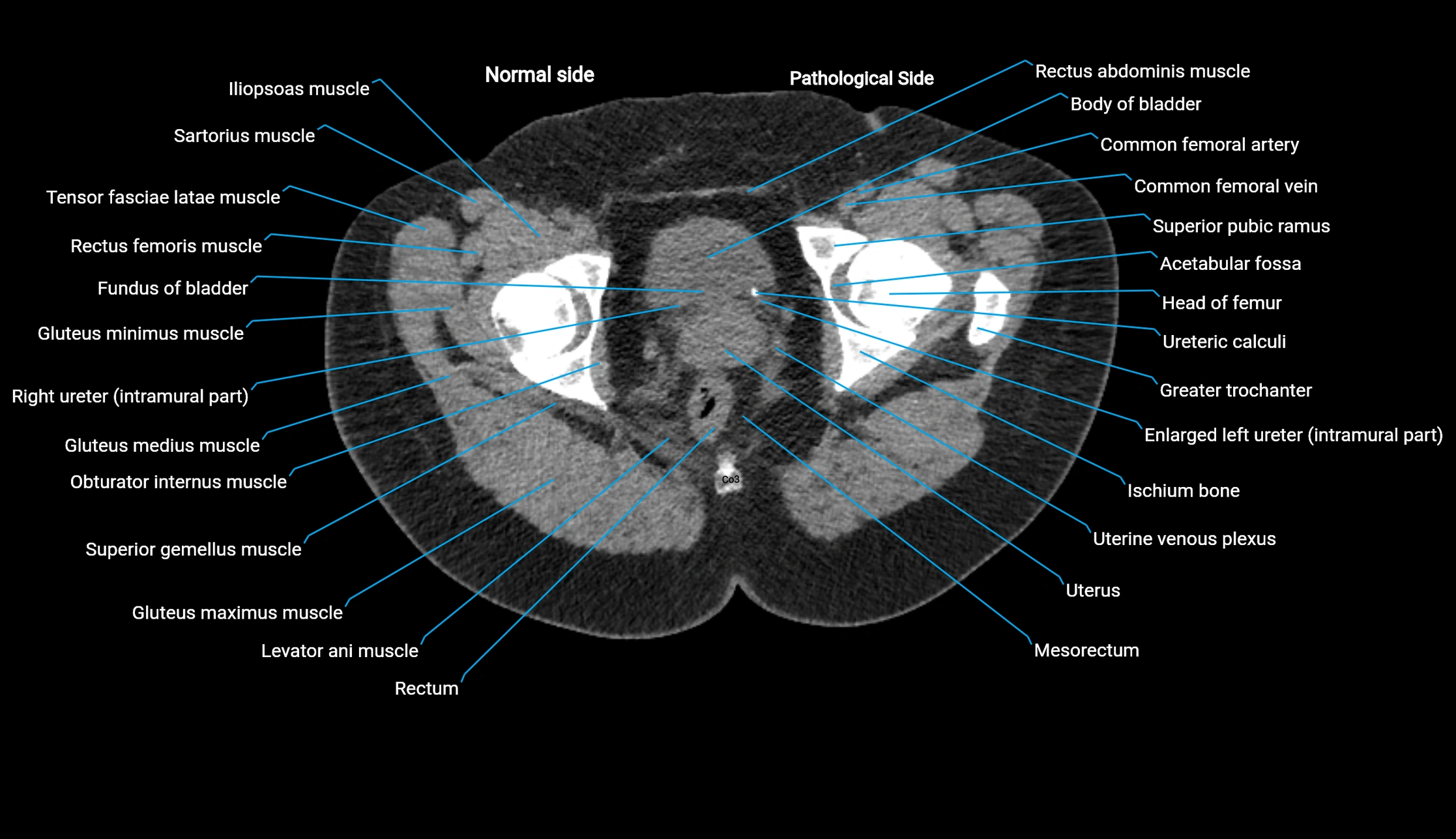 CT KUB axial cross sectional anatomy  radiology image -img-00201-00160.webp